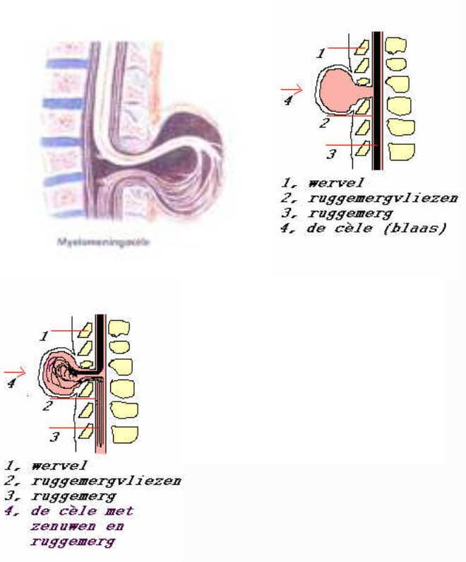 uitleg-wat-is-Spina-bifida